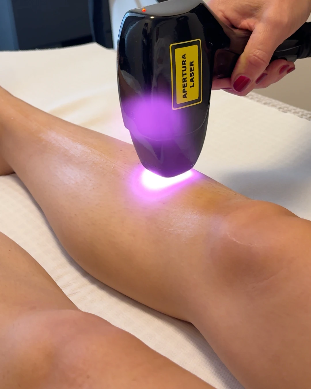 epilazione laser